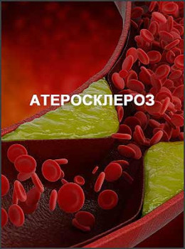 Атеросклероз