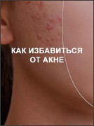 Как избавиться от акне