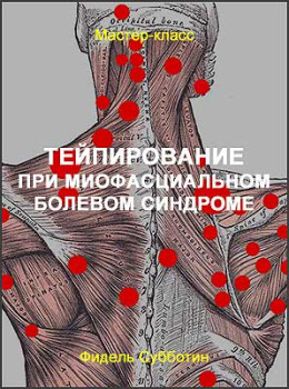 Тейпирование при миофасциальном болевом синдроме